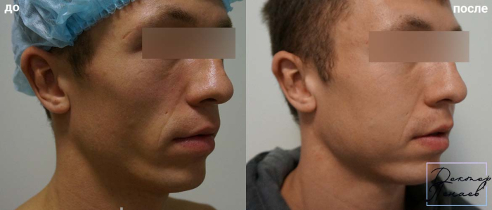 Пациент пластического хирурга Арслана Пенаева до и после липофилинга лица