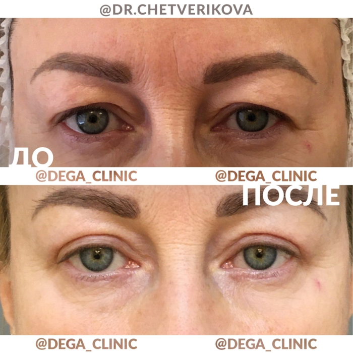 Пациентка доктора Марины Четвериковой до и после блефаропластики