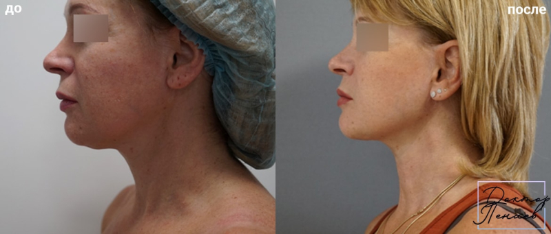 Пациентка пластического хирурга Арслана Пенаева до и после подтяжки лица нитями Spring Threads