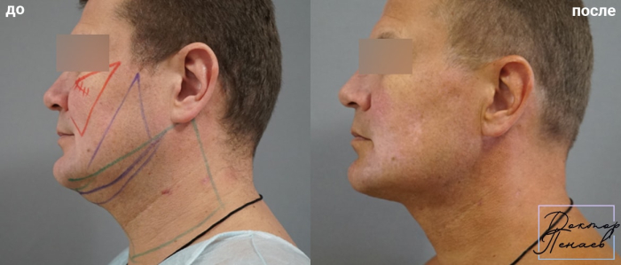 Пациент пластического хирурга Арслана Пенаева до и после безоперационной подтяжки лица