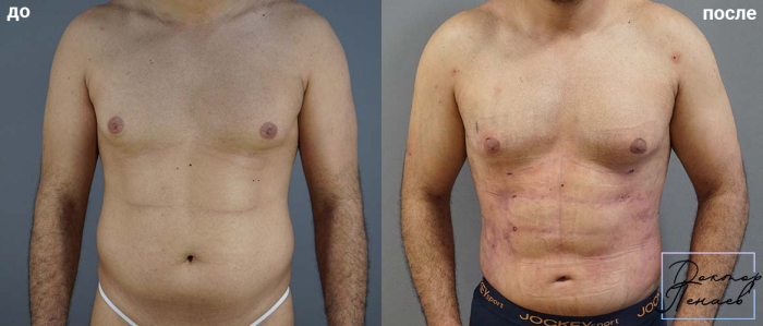 Пациент доктора Пенаева А.А. Мужчине была проведена VASER-липосакция High Definition.