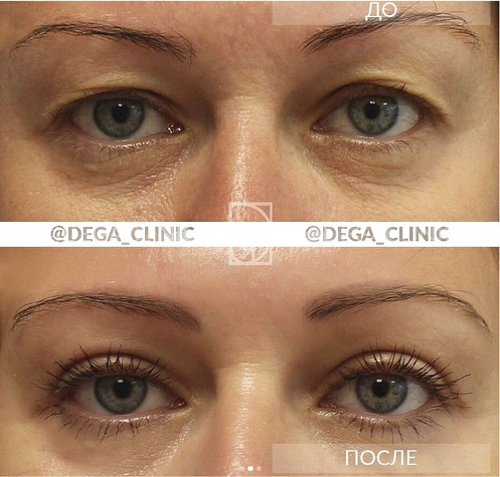 Пациентка доктора Екимова до и после блефаропластики