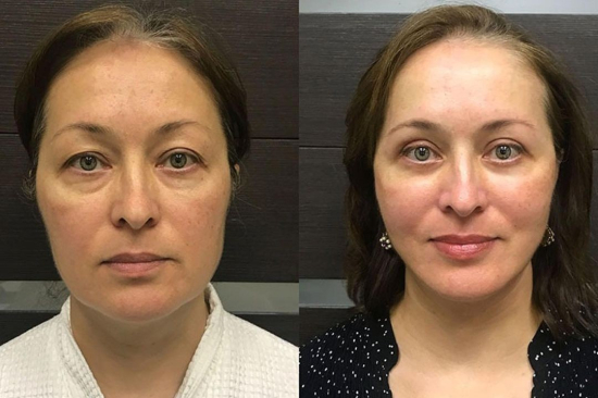 Подтяжка лица Ольга Ованесова