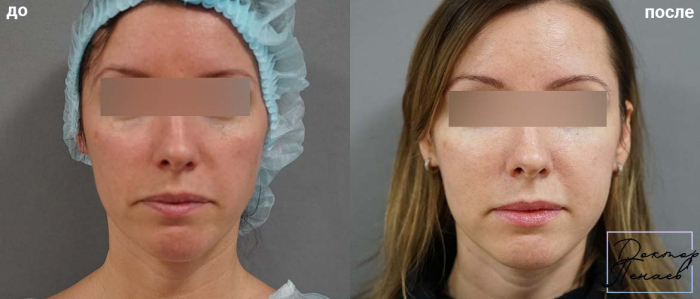 Пациентка пластического хирурга Арслана Пенаева до и после липофилинга лица