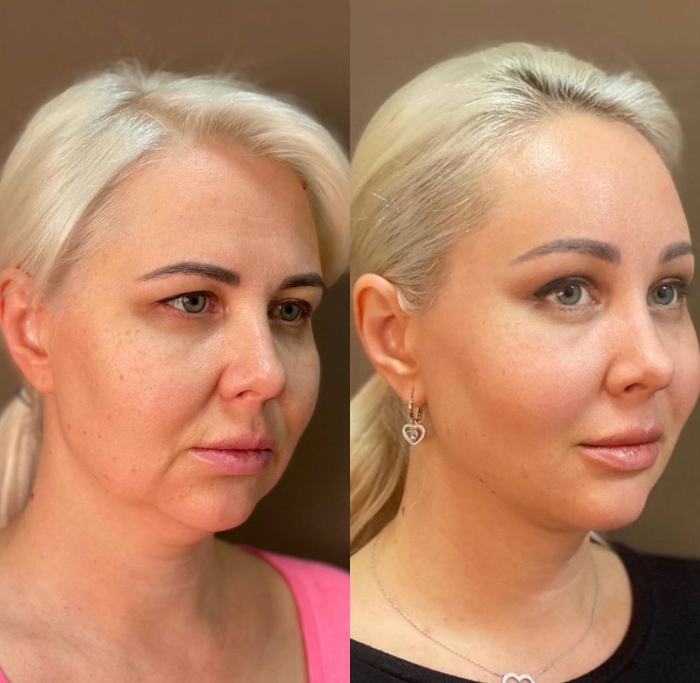 Пациентка пластического хирурга Светланы Пшонкиной до и после омоложения лица.