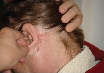 Швы после подтяжки лица