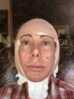 Как выглядят пациенты во время реабилитации после подтяжки лица