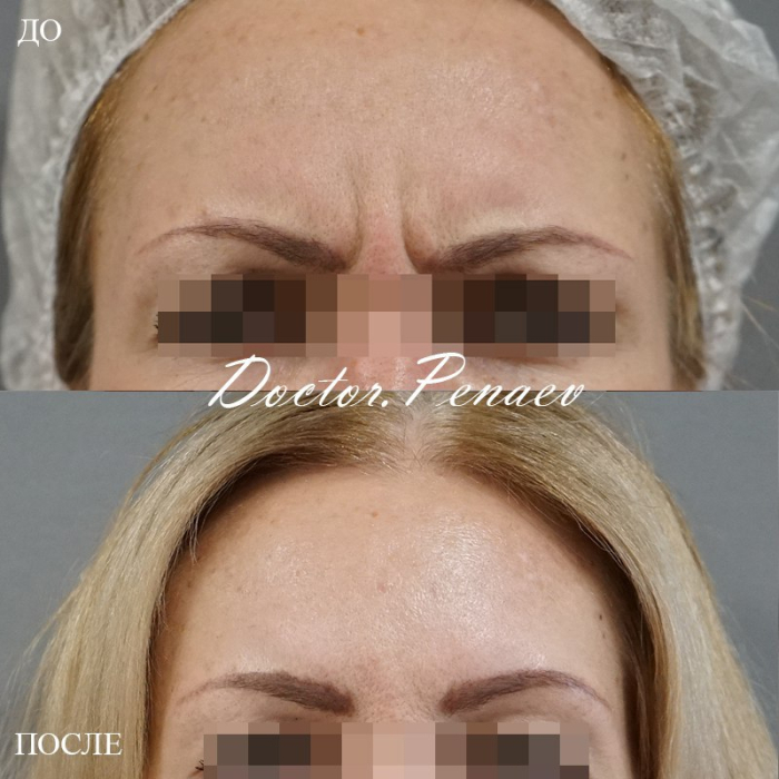 Пациентка доктора Арслана Пенаева до и после процедуры Вечный Ботокс.