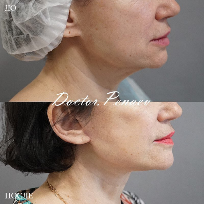 Пациентка (67 лет) доктора Арслана Пенаева до и после омолаживающей операции.