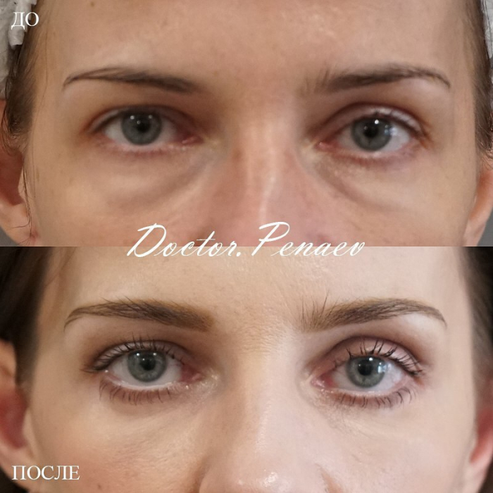 Пациентка доктора Арслана Пенаева до и после нижней блефаропластики