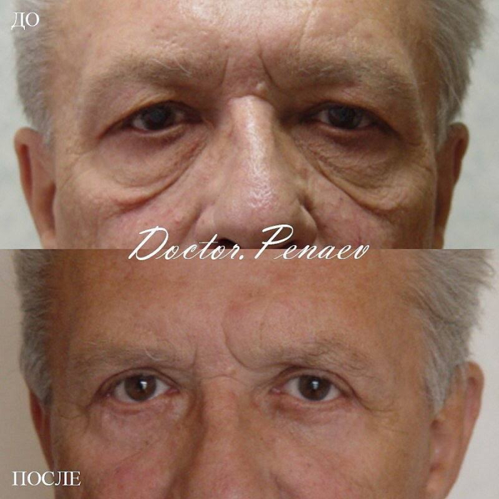 Пациент доктора Пенаева до и после блефаропластики, кантопексии и височного лифтинга