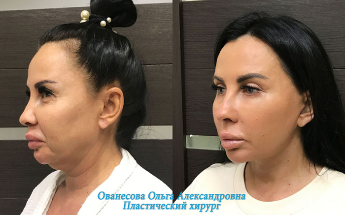 Пациентка пластического хирурга Ольги Ованесовой до и после подтяжки лица и шеи в Москве