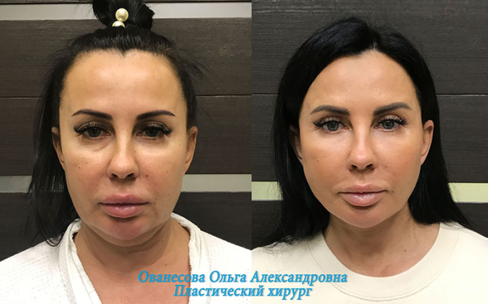 Пациентка пластического хирурга Ольги Ованесовой до и после подтяжки лица и шеи