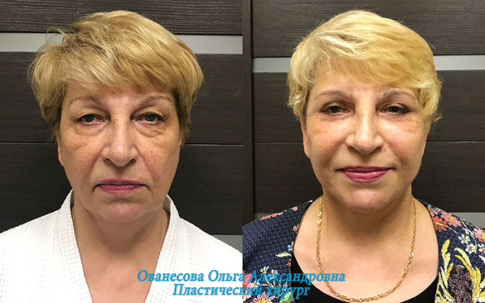 Пациентка пластического хирурга Ольги Ованесовой до и после комплексной подтяжки лица и шеи