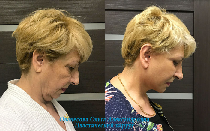 Пациентка пластического хирурга Ольги Ованесовой до и после комплексного омоложения лица и шеи