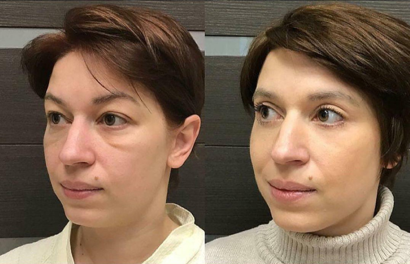 Пациентка доктора Ольги Ованесовой до и после удаления малярных мешков