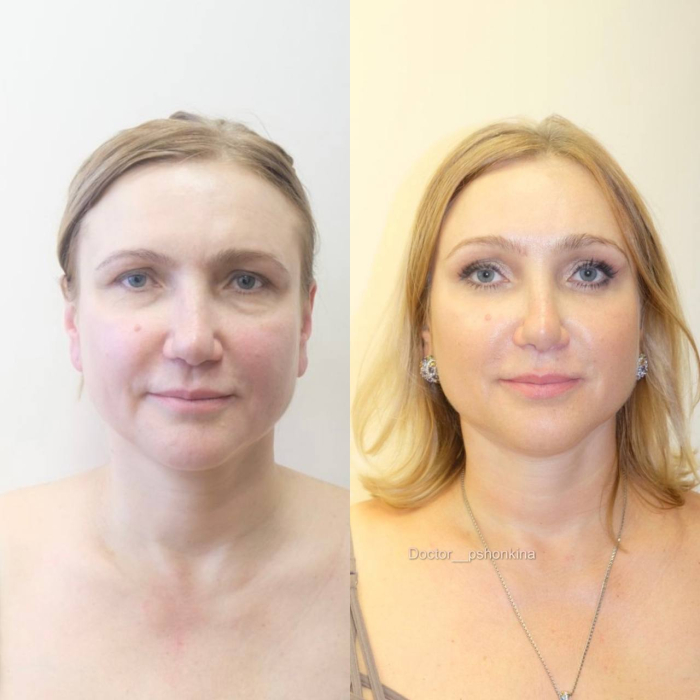 Пациентка пластического хирурга Светланы Пшонкиной до и после эндоскопической подтяжки лица