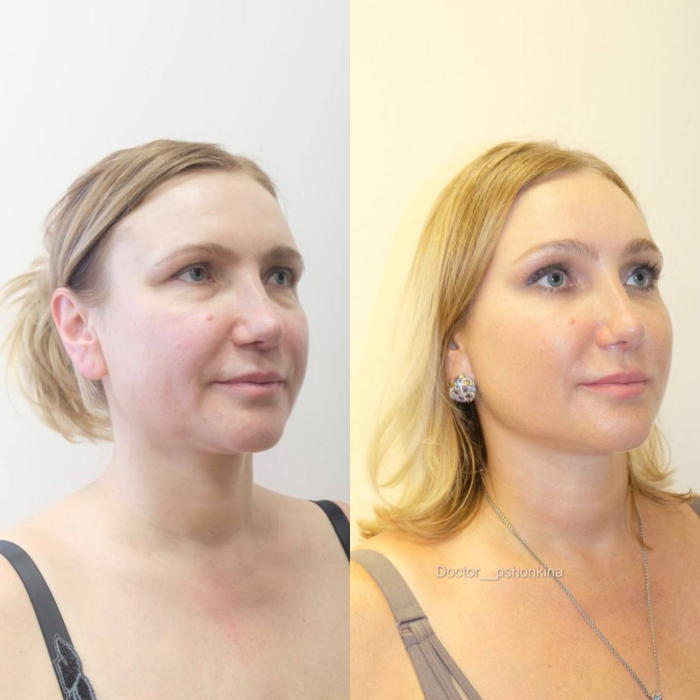Пациентка пластического хирурга Светланы Пшонкиной до и после эндоскопической подтяжки лица