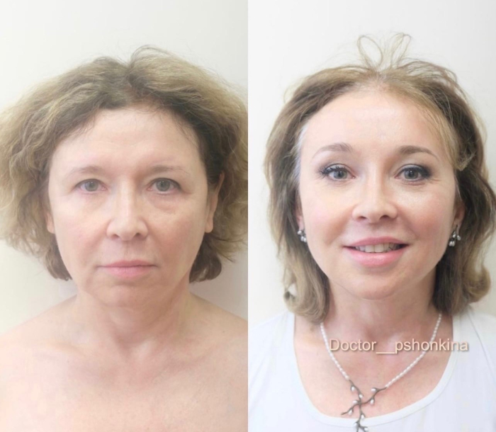 Пациентка пластического хирурга Светланы Пшонкиной. Фото до и после эндоскопической подтяжки лица и рф-лифтинга Фрактора