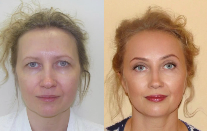 Пациентка пластического хирурга Светланы Пшонкиной. Фото до и после эндоскопической подтяжки лба