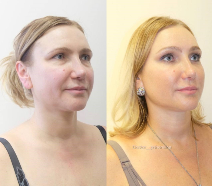 Пациентка пластического хирурга Светланы Пшонкиной. Фото до и после эндоскопического омоложения лица.