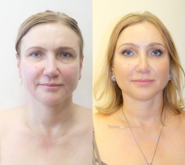 Пациентка пластического хирурга Светланы Пшонкиной. Фото до и после эндоскопического омоложения лица