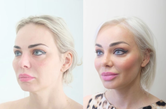 Пациентка пластического хирурга Светланы Пшонкиной. Фото до и после эндоскопической подтяжки лица.