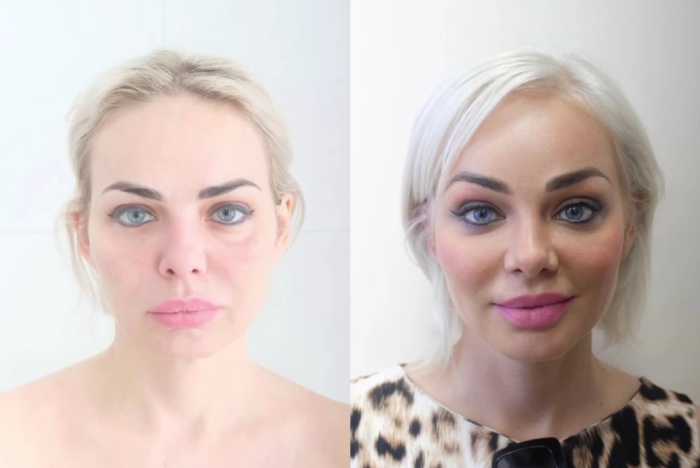 Пациентка пластического хирурга Светланы Пшонкиной. Фото до и после эндоскопической подтяжки лица