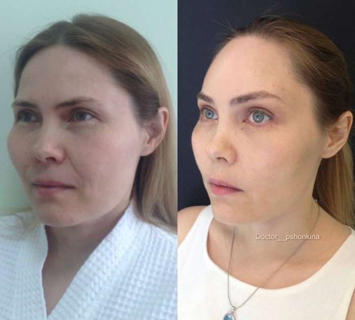 Пациентка пластического хирурга Светланы Пшонкиной. Фото до и после эндоскопической подтяжки лица в Москве.