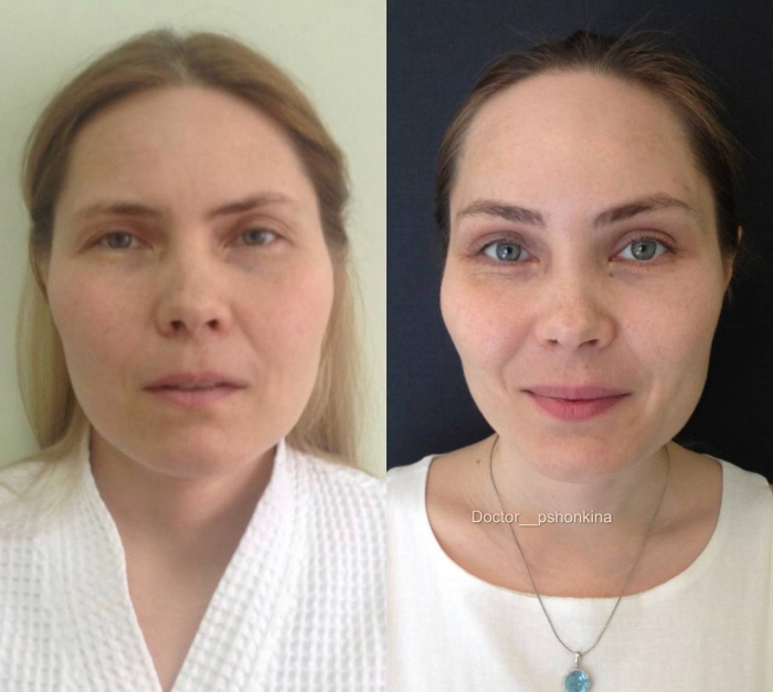 Пациентка пластического хирурга Светланы Пшонкиной. Фото до и после эндоскопической подтяжки лица в Москве