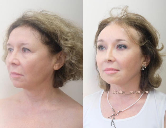 Пациентка пластического хирурга Светланы Пшонкиной. Фото до и после эндоскопической подтяжки лица и лифтинга Фрактора