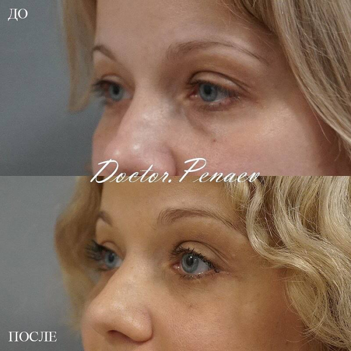 Пациентка пластического хирурга Арслана Пенаева. Фото до и после нижней блефаропластики век