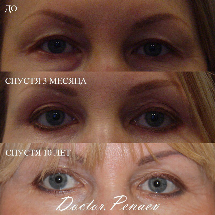 Пациентка пластического хирурга Арслана Пенаева. Фото до и после круговой блефаропластики.