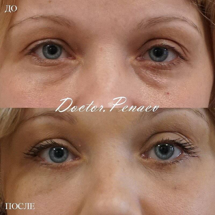 Пациентка пластического хирурга Арслана Пенаева. Фото до и после нижней блефаропластики.
