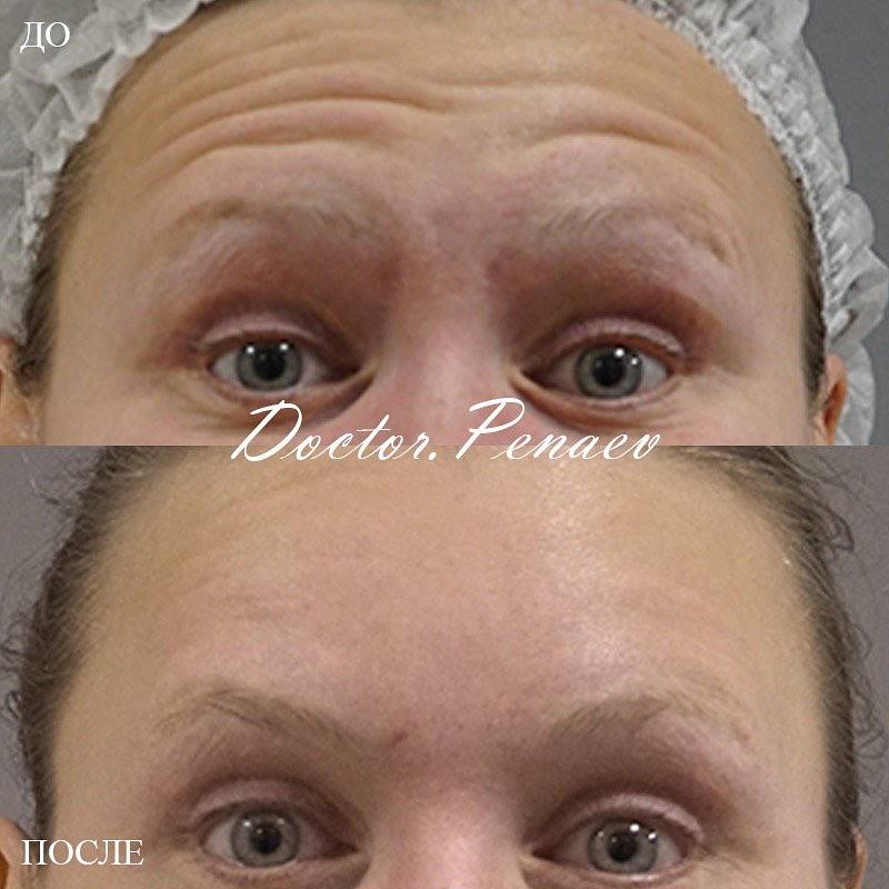 Пациентка хирурга Арслана Пенаева до и после методики Вечный Ботокс