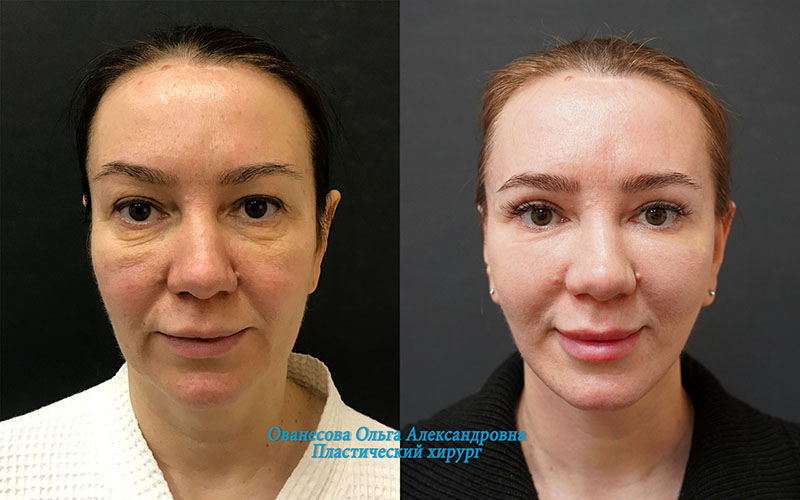 Пациентка доктора Ольги Ованесовой. Женщине было выполнено комплексное омоложение лица и частичное удаление малярных образований