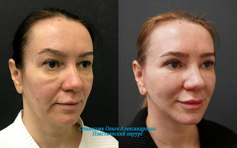 Пациентка доктора Ольги Ованесовой. Женщине было выполнено комплексное омоложение лица и частичное удаление малярных образований