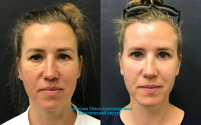 Пациент Наталья, 41 год.