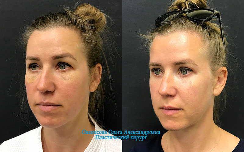 Пациентка доктора Ольги Ованесовой. Женщине выполнена круговая блефаропластика и удаление малярных образований
