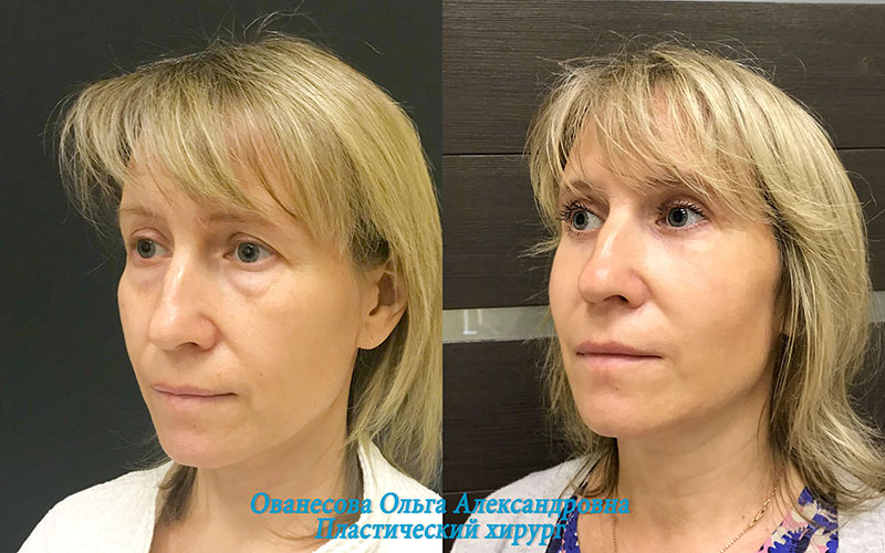 Пациентка доктора Ольги Ованесовой. Женщине было выполнена круговая блефаропластика и удаление малярных образований