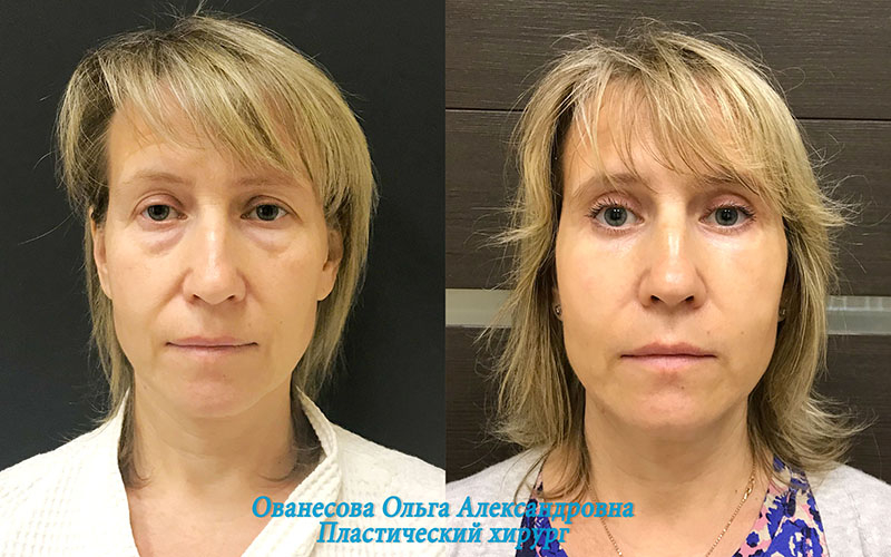 Пациентка доктора Ольги Ованесовой. Женщине было выполнена круговая блефаропластика и удаление малярных образований
