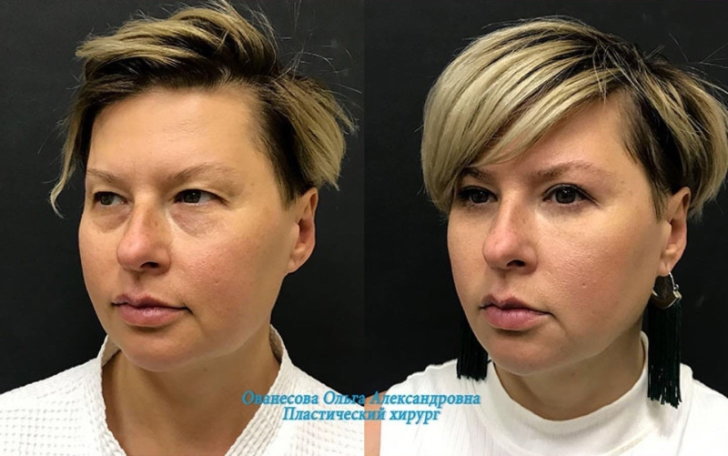Пациентка доктора Ольги Ованесовой. Женщине было выполнена круговая блефаропластика и удаление малярных образований
