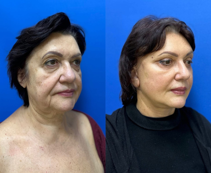 Пациентка пластического хирурга Светланы Пшонкиной до и через месяц после круговой подтяжки лица