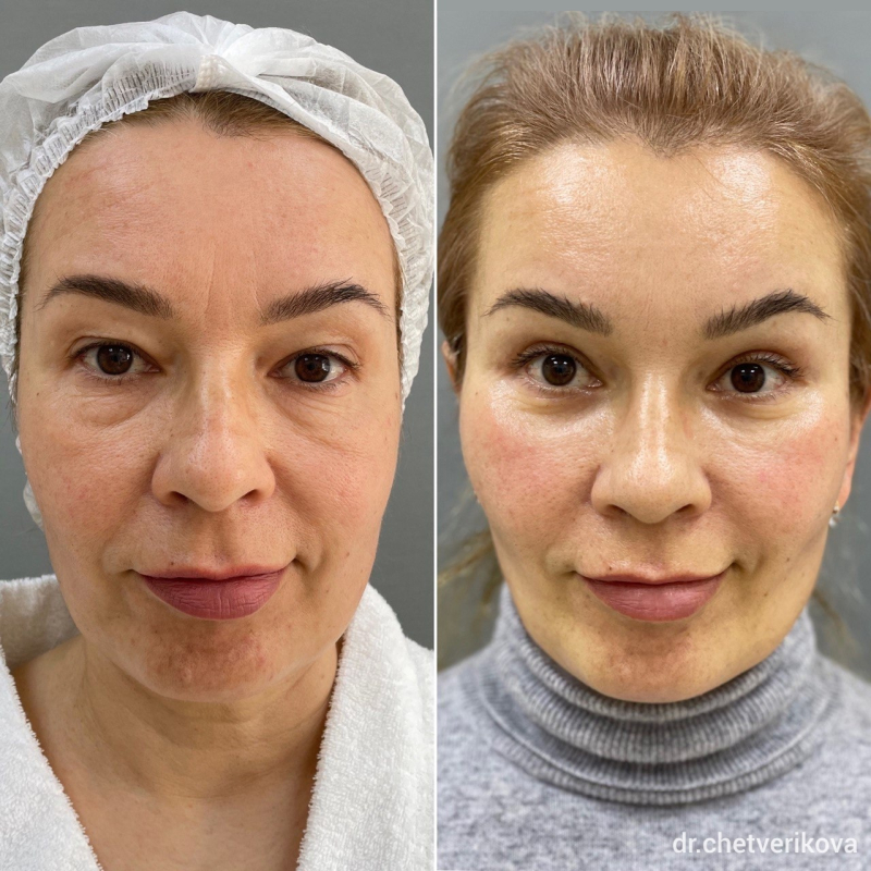 Пациентка пластического хирурга Марины Четвериковой до и через несколько месяцев после комплексного омоложения лица