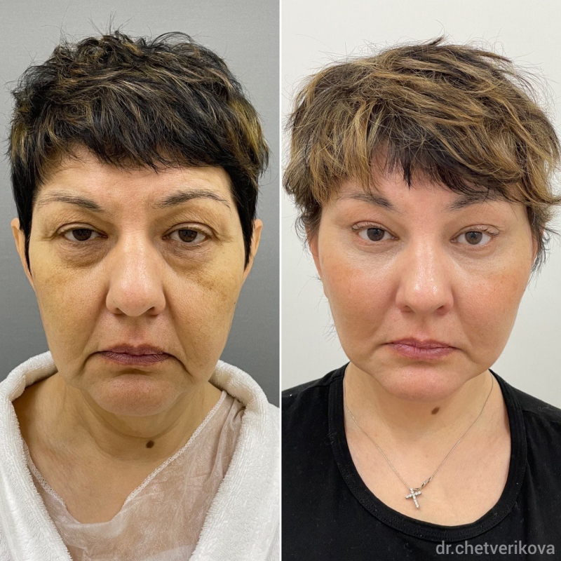 Пациентка пластического хирурга Марины Четвериковой до и через 3 месяца после комплексного омоложения лица