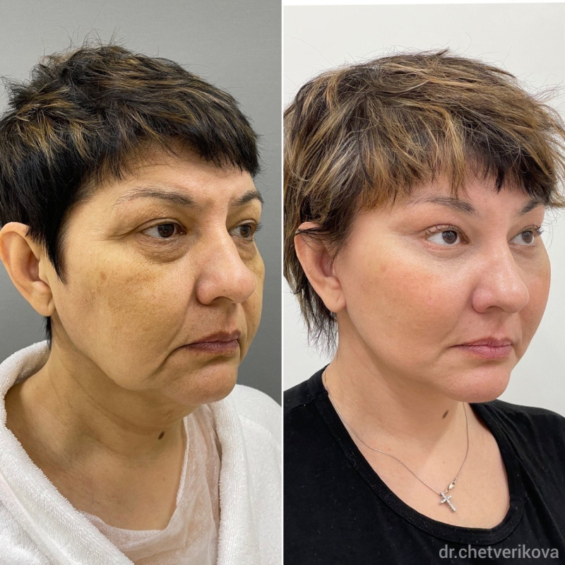 Пациентка пластического хирурга Марины Четвериковой до и через 3 месяца после комплексной операции по омоложению лица