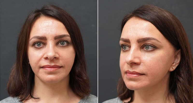 Пациентка пластического хирурга Ольги Ованесовой после комплексного омоложения.