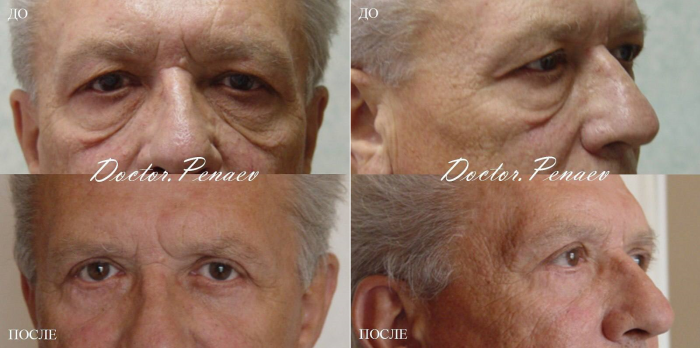 Пациент профессора Пенаева А.А. до и после блефаропластики и кантопексии