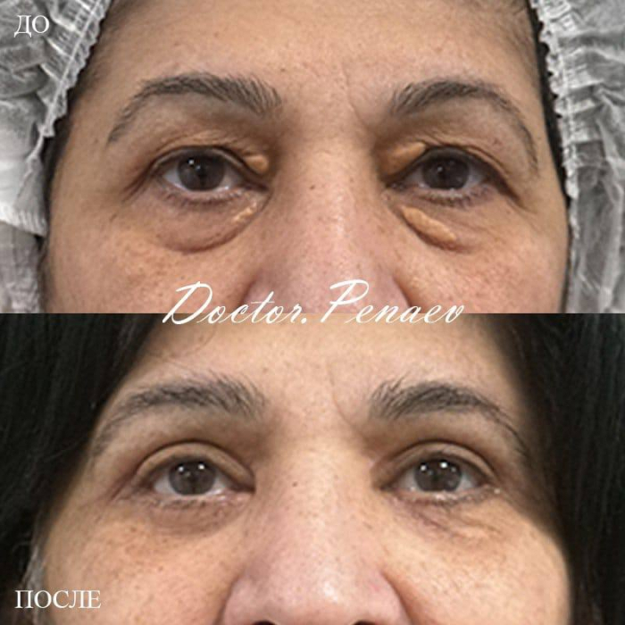 Пациентка профессора Пенаева А.А. до и после блефаропластики верхних и нижних век