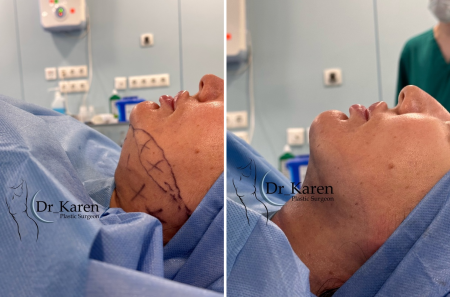 Пациентка пластического хирурга Карена Пайтяна. Операция по липомоделирования подбородка